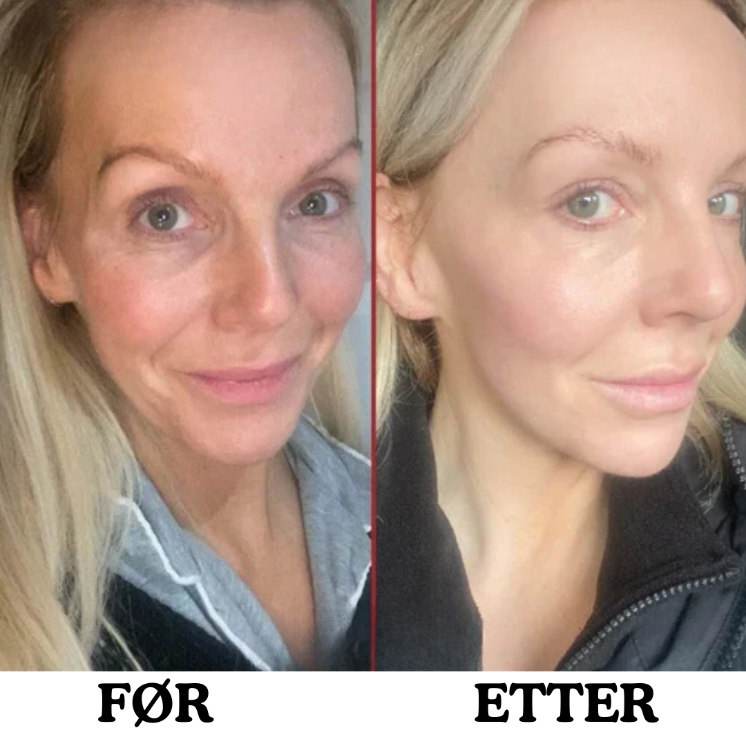 Instalift anti-aldrings ansiktsstift