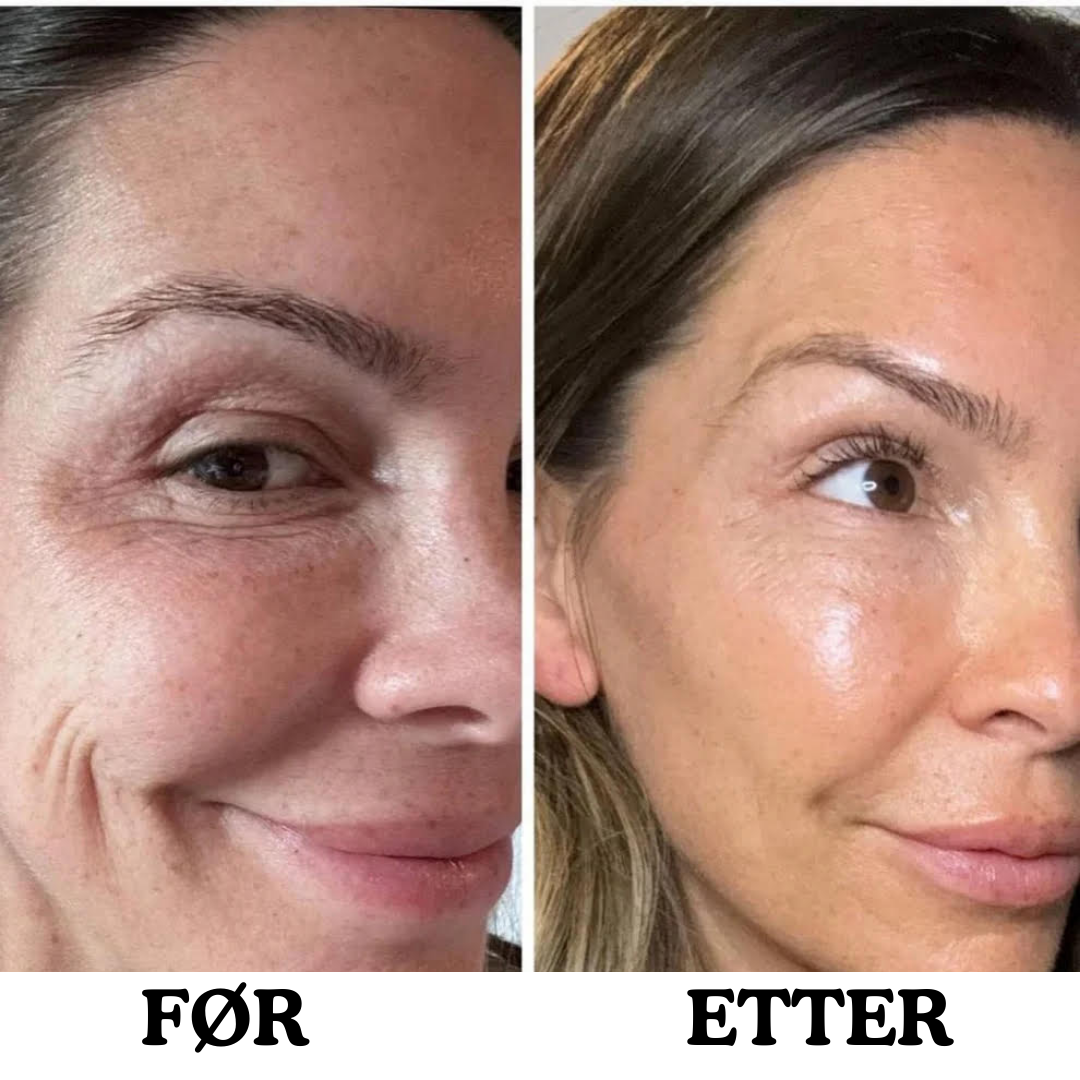 Instalift anti-aldrings ansiktsstift